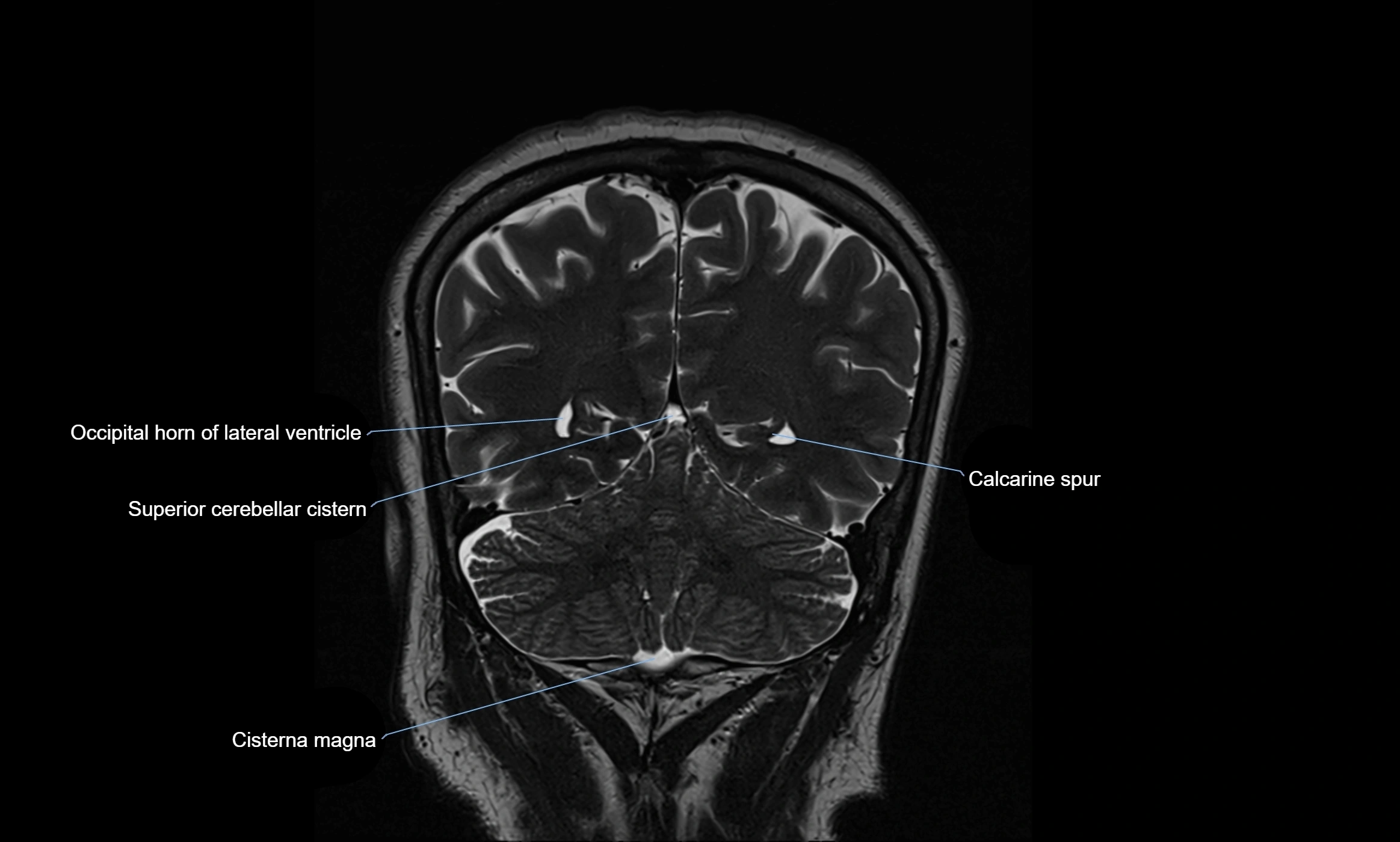 Brain cisterns  and ventricles coronal anatomy 3T MRI image-img-00001-00046.webp